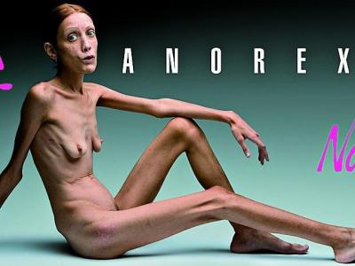 ANOREXIA